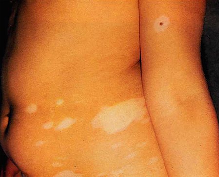 Macula achromica (vitiligo)